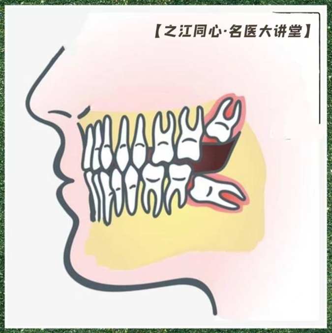 口腔健康  全身健康  专家提醒及时清除口腔内的“定时炸弹”